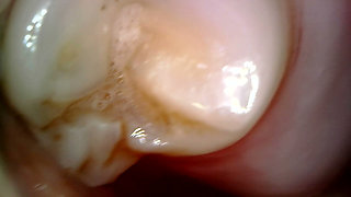 Medical Endoscope Oral Exam: Gummy Chewing, Extreme Teeth & Tongue Macro